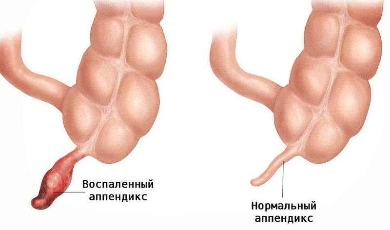 Аппендикс